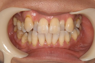 口元のバランスとかみ合わせを考慮した成人歯列矯正 歯列矯正歯科専門の歯科クリニック
